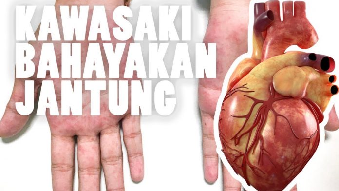 Kenali Penyakit Kawasaki yang Bahayakan Jantung Anak.