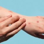 WHO Tetapkan Cacar Monyet Darurat Kesehatan Global