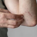 ilustrasi cacar monyet