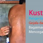 Mengenal Penyakit Kusta atau Lepra, Penyebab, Gejala serta Pengobatannya.