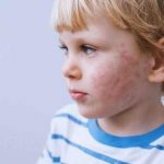 Flu Tomat: Penyakit Baru dari India yang Sudah Menyerang 82 Anak