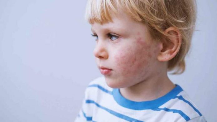 Flu Tomat: Penyakit Baru dari India yang Sudah Menyerang 82 Anak