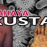 Mengenal Penyakit Kusta atau Lepra, Penyebab, Gejala serta Pengobatannya