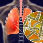 Penyakit Legionnaire Dikabarkan Lebih Parah Dari Covid.