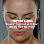 Mengenal Penyakit Lupus: Pengertian, Jenis serta Penyebabnya.