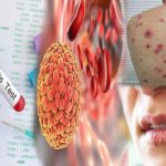 Mengenal Penyakit Sifilis: Gejala, Penyebab, serta Pengobatannya