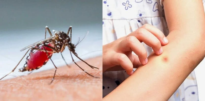 Tips Hilangkan Bekas Gigitan Nyamuk