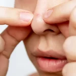 Tips Mudah Cegah Komedo