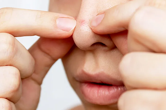 Tips Mudah Cegah Komedo