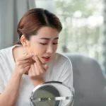 Tips Mudah Cegah Komedo