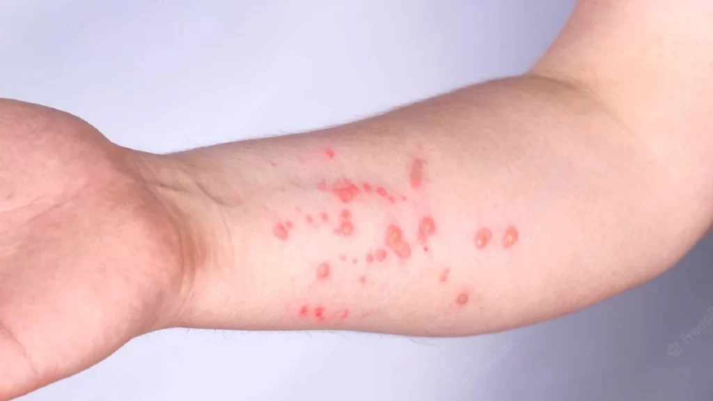 Cacar Monyet di Jakarta