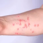 Cacar Monyet di Jakarta