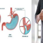 Cara Mengobati GERD dan Maag Tanpa Obat