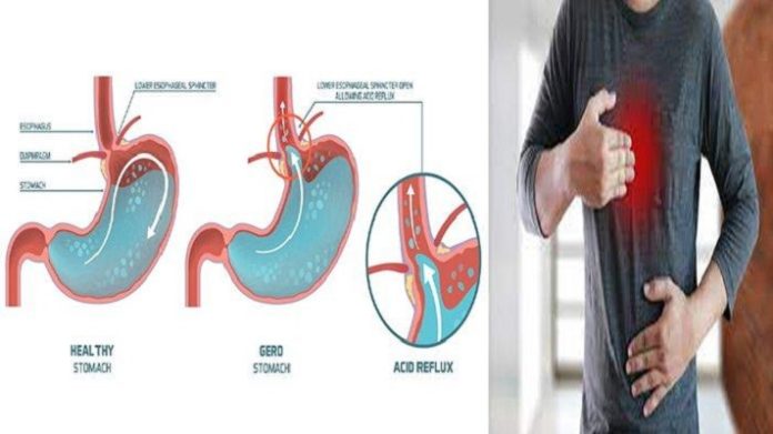 Cara Mengobati GERD dan Maag