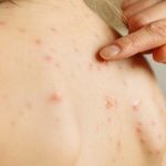 Waspada-Kelompok-Paling-Rentan-Terkena-Cacar-Monyet-Kenali-Gejalanya