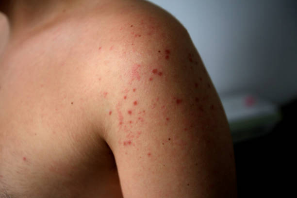 Dinkes DKI Cacar Monyet