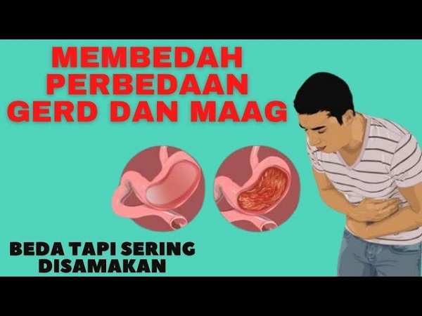 Cara Mengobati GERD dan Maag