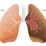 Mengenal Penyakit Kanker Paru: Pengertian, Diagnosis serta Pencegahannya.