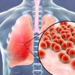 ILUSTRASI-Penyakit-pneumonia-sabtu-02122023