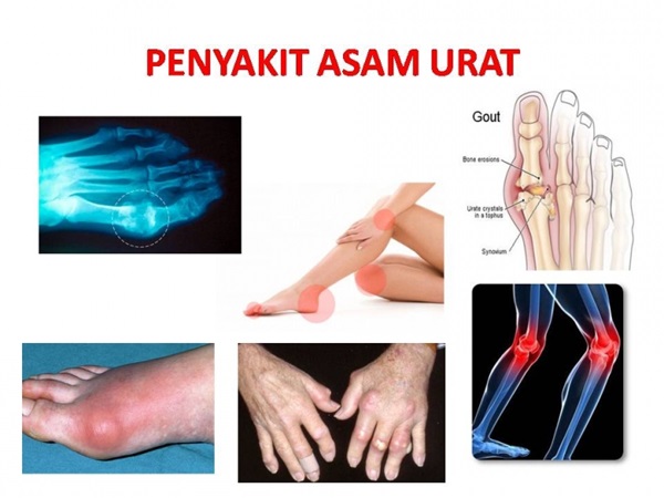 Mengenal Penyakit Asam Urat atau Gout