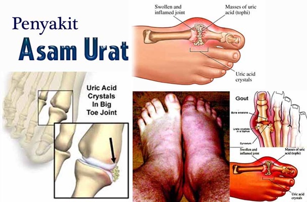 Mengenal Penyakit Asam Urat atau Gout