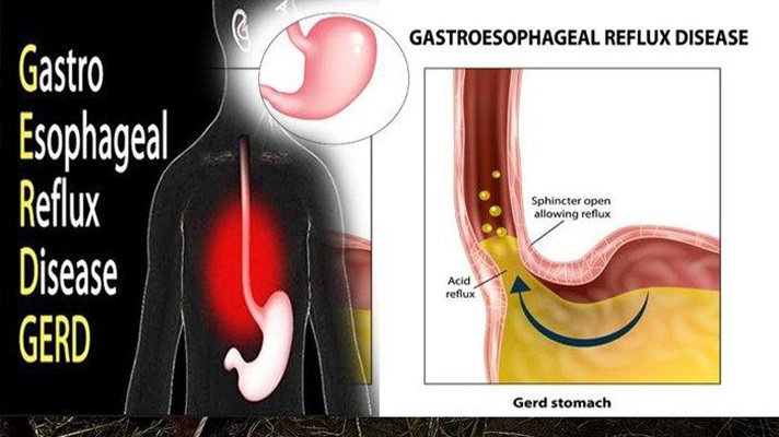 Daftar Makanan Terburuk Untuk Penderita Asam