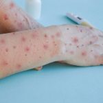 ilustrasi-monkeypox-istock_ratio-16×9