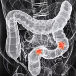 079362300_1552991771-Waspadai-5-Gejala-Kanker-Kolon-Ini-By-Sebastian-Kaulitzki-Shutterstockjpg