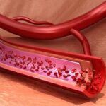 penyebab-pembuluh-darah-pecah-beserta-cara-mencegahnya-wajib-diketahui