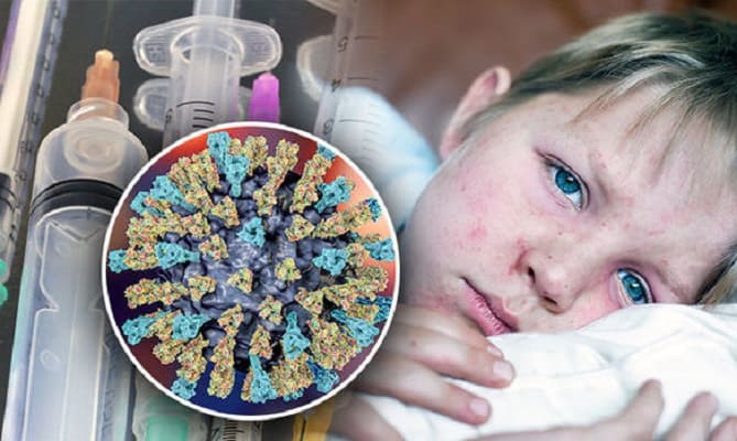 Mengenal Virus Campak