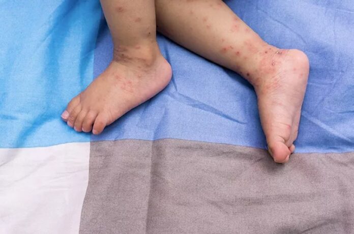 Kemenkes Kewaspadaan Penyakit Campak